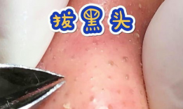 黑头视频,揭秘黑头成因及有效去除方法